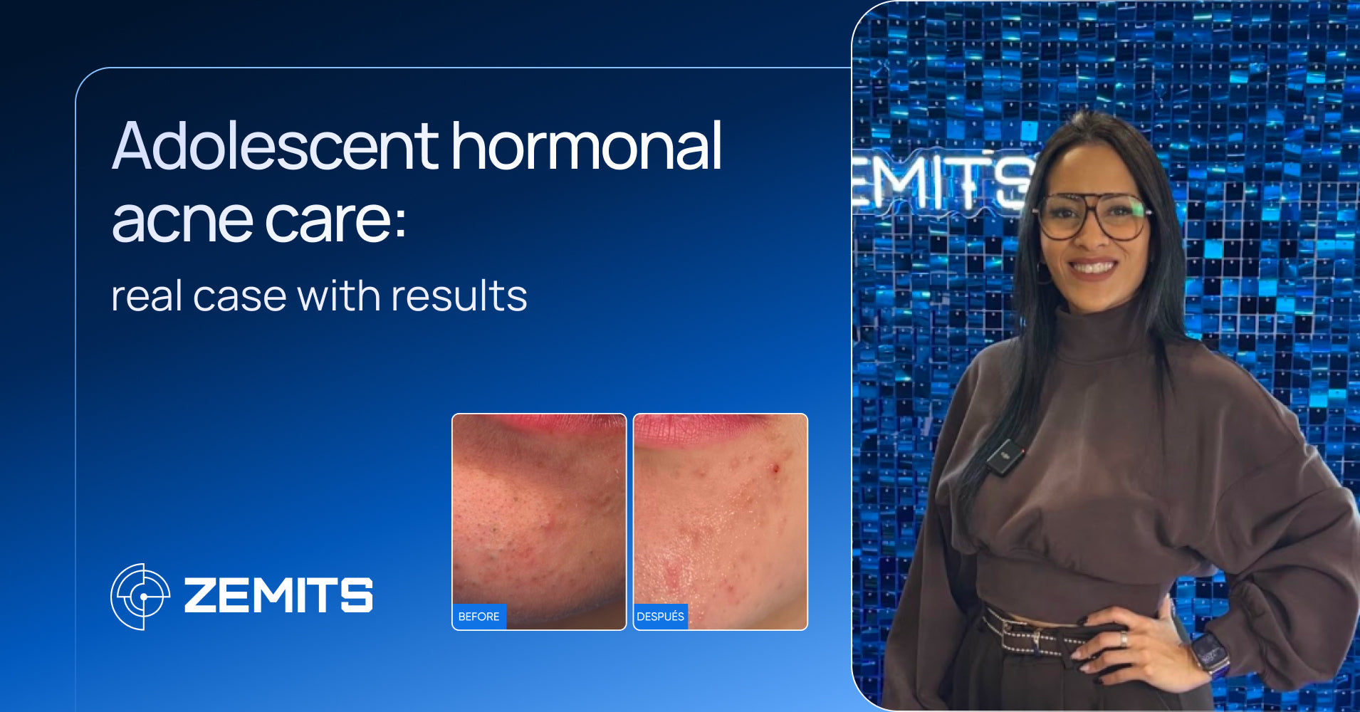 Adolescent Hormonal Acne Treatment: Real Case with Results