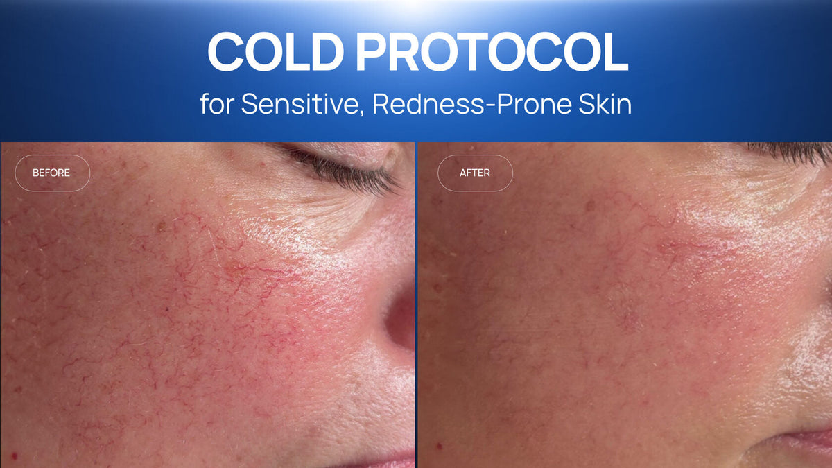 How a Cold Plasma and Cooling Protocol Calmed Sensitive,  Redness-Prone Skin in Two Sessions