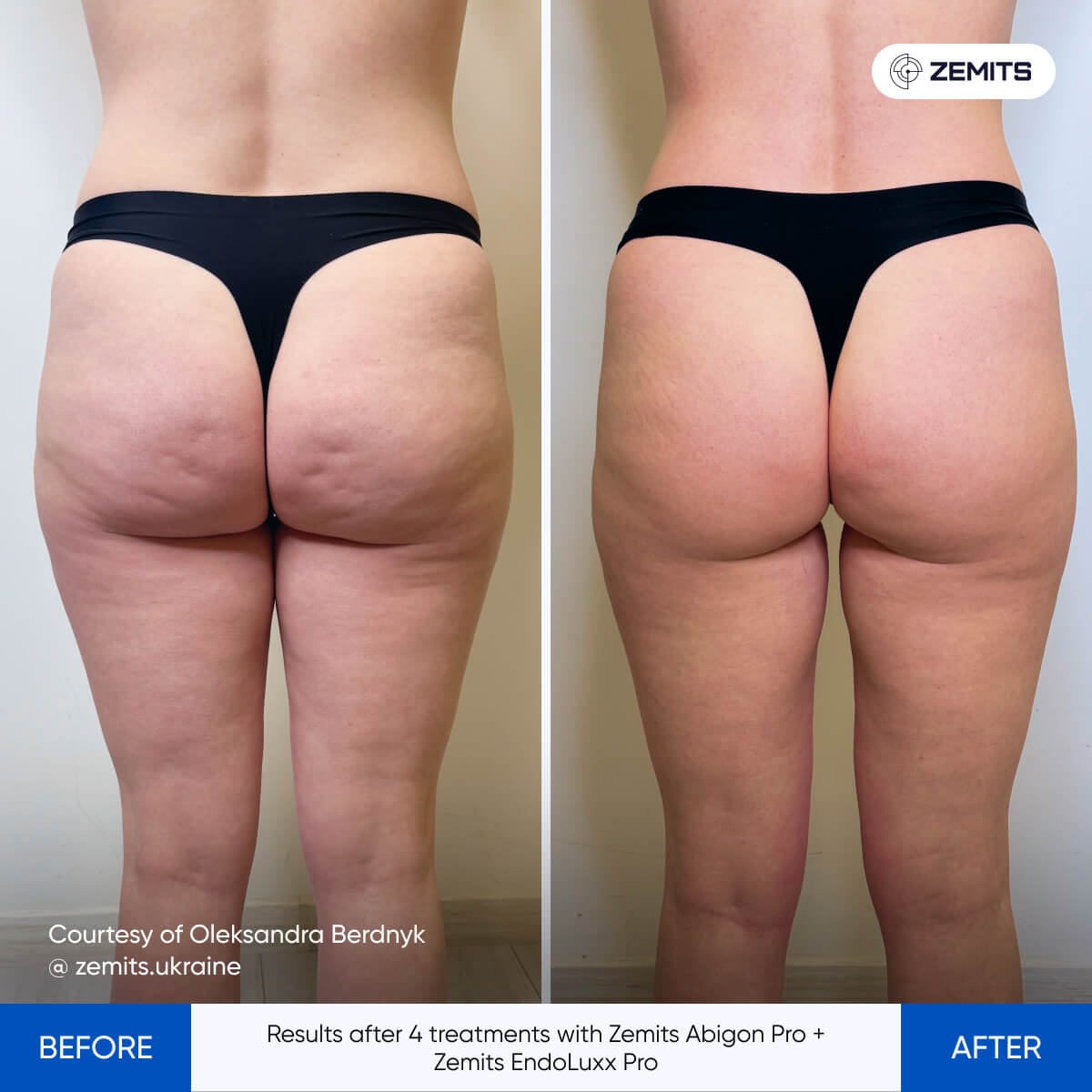 Zemits EndoLuxx Pro: Deep Tissue Contouring for Face & Body