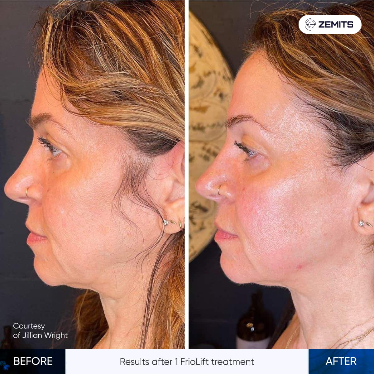 Before After Slide 6