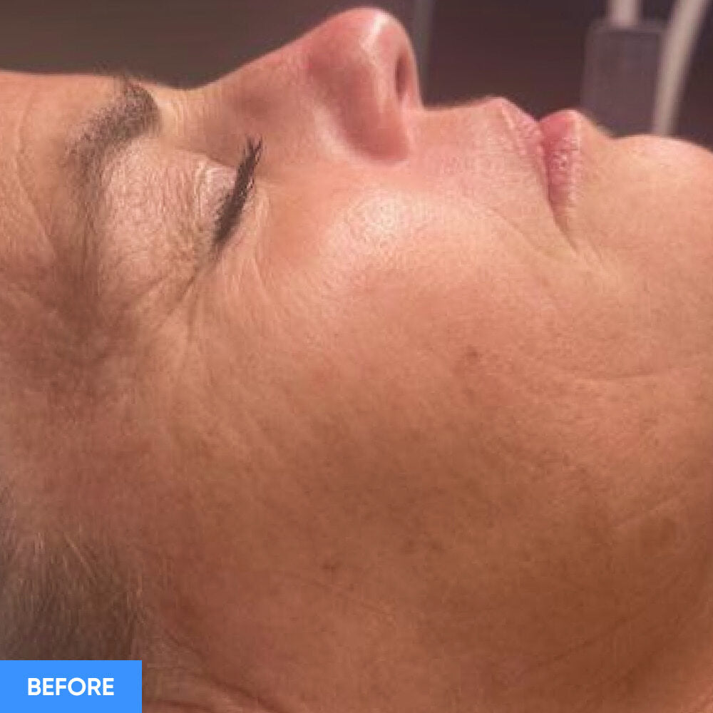 Before After Slide 1