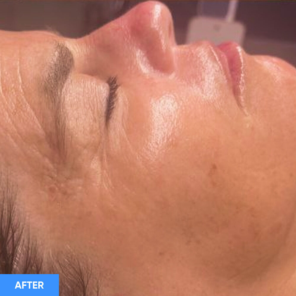 Before After Slide 2