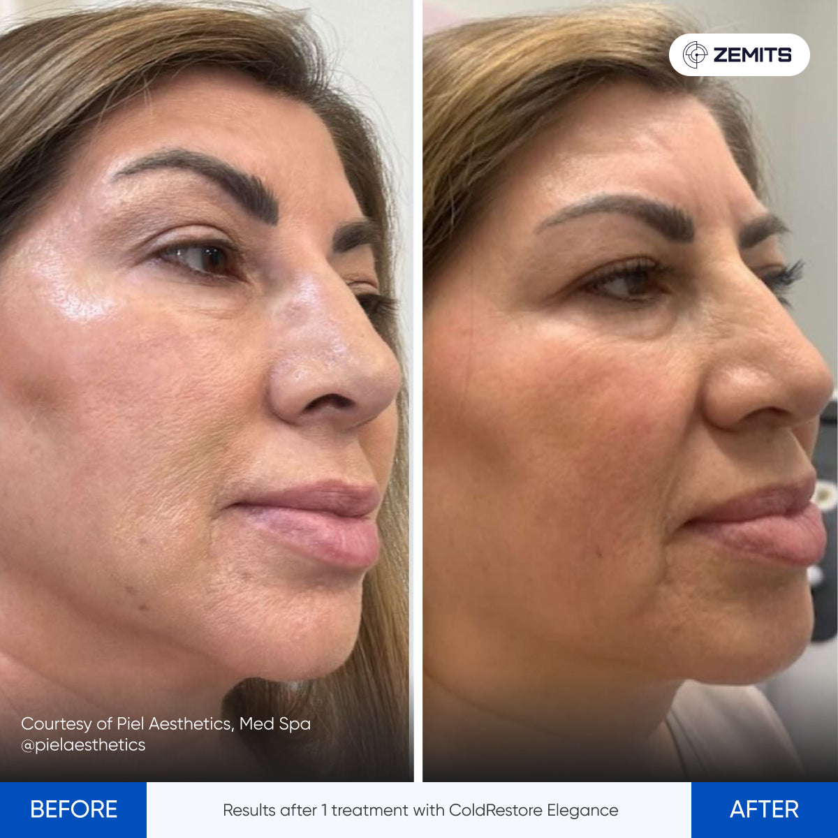 Before After Slide 13