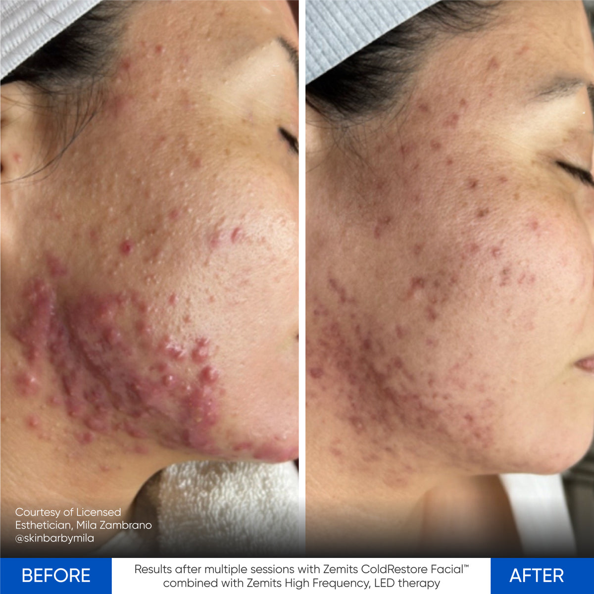 Before After Slide 17