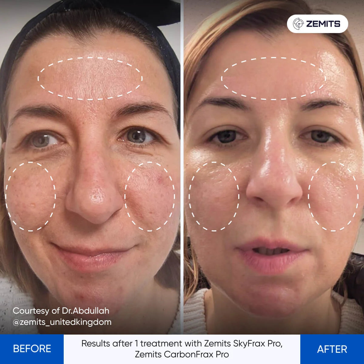Zemits SkyFrax Pro: Fractional RF Microneedling System – Zemits EU