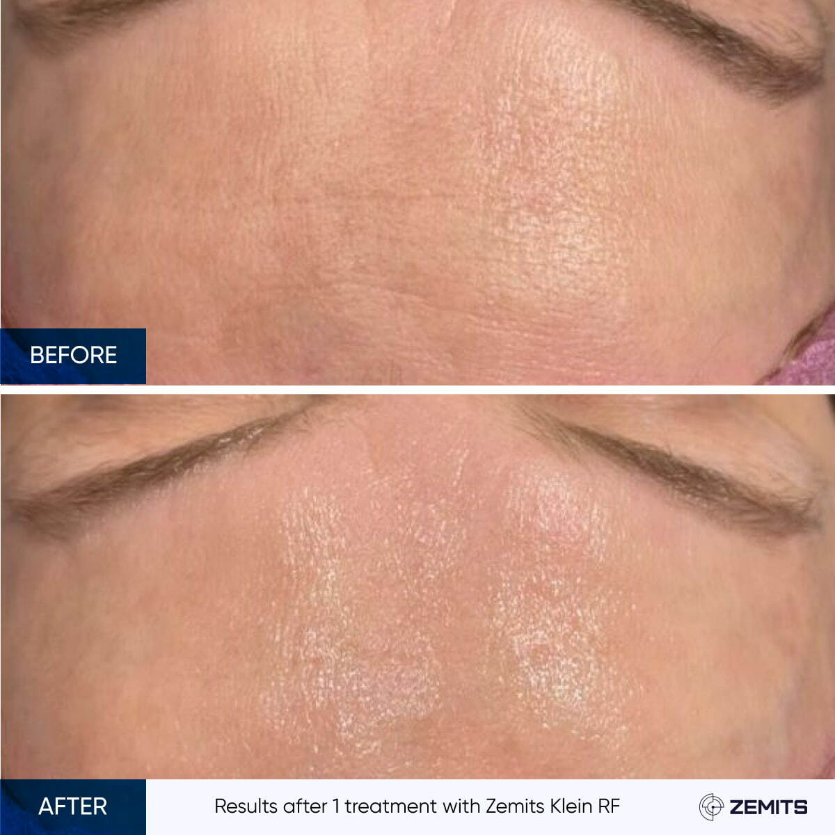 Before After Slide 11