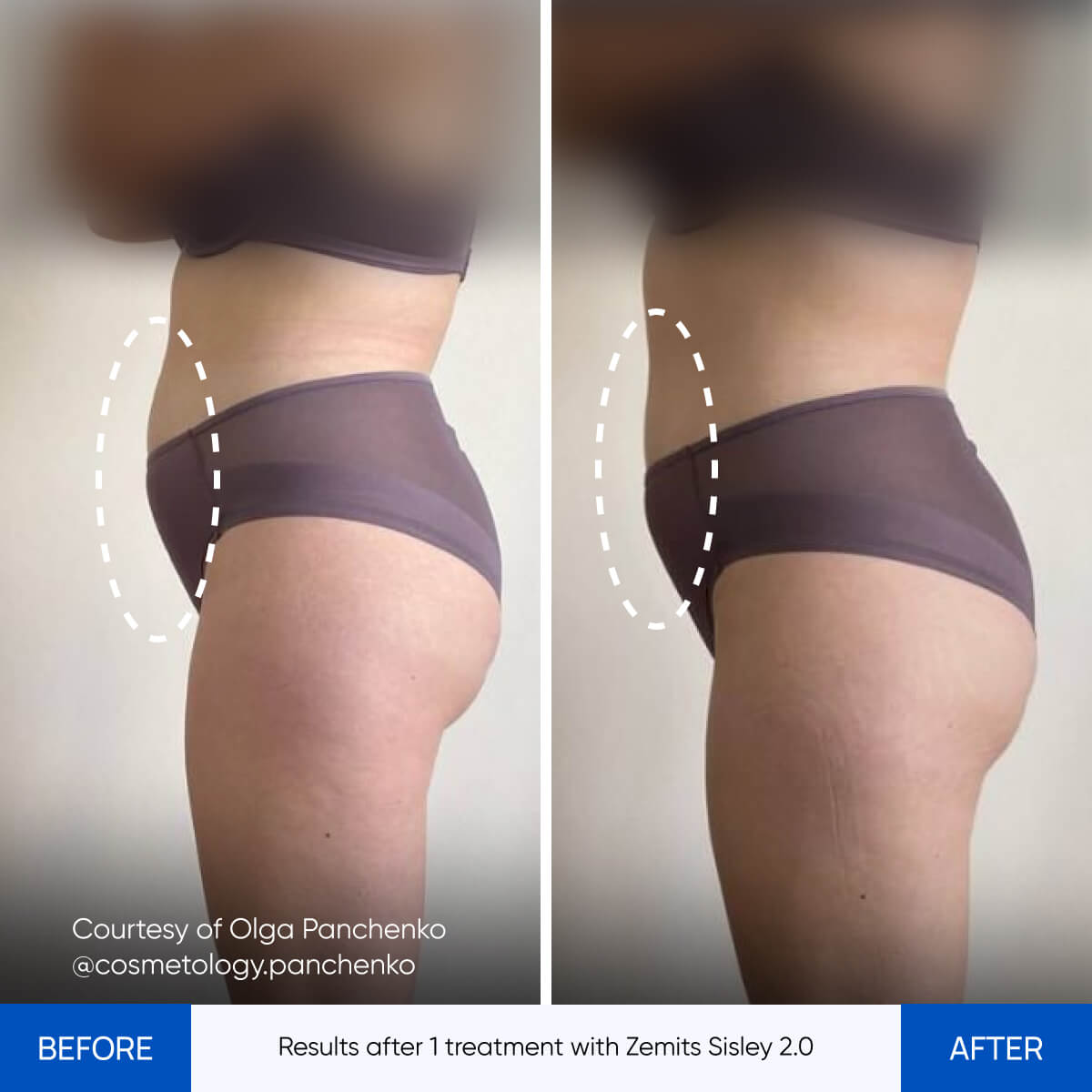 Before After Slide 1