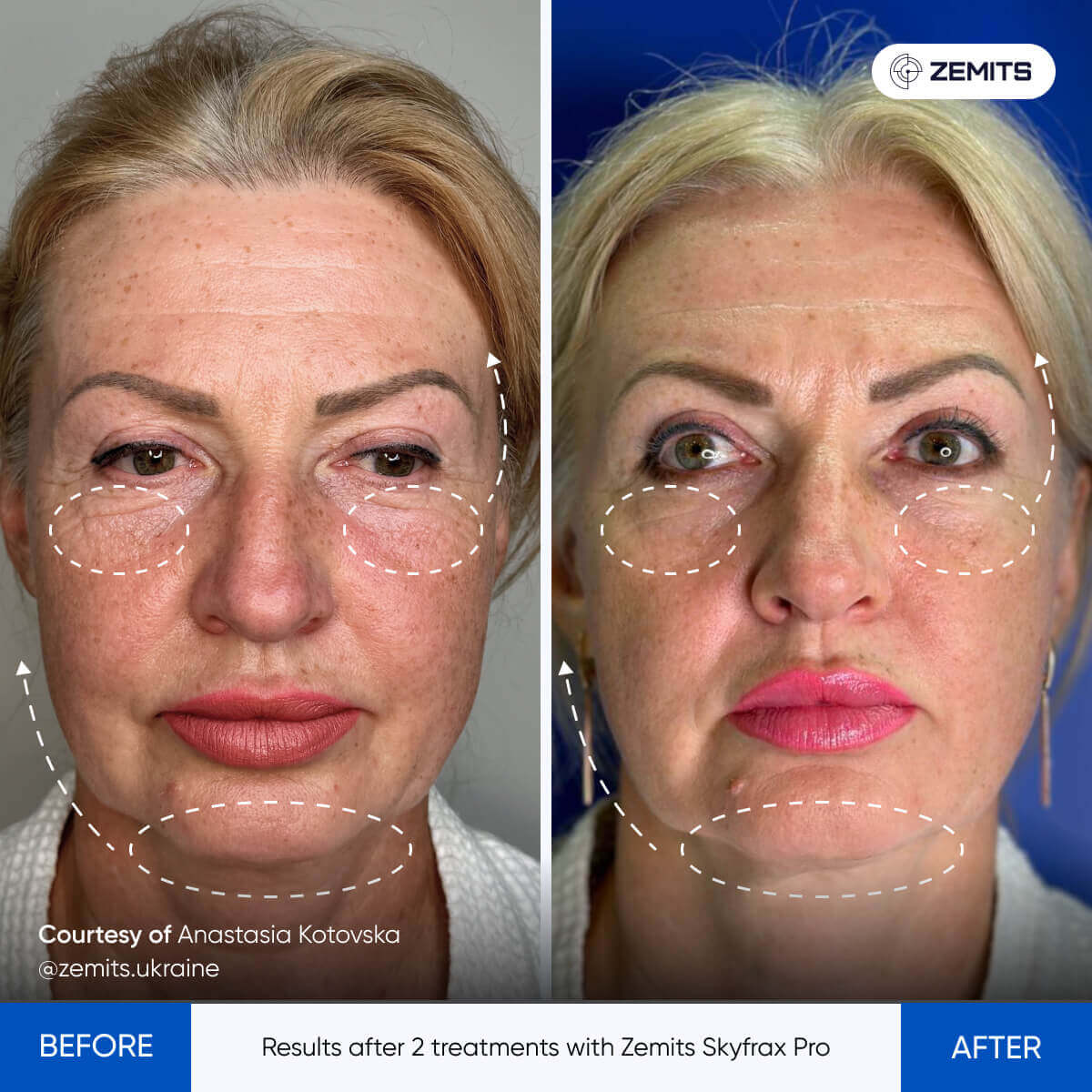 Zemits SkyFrax Pro Fractional Radiofrequency Microneedling