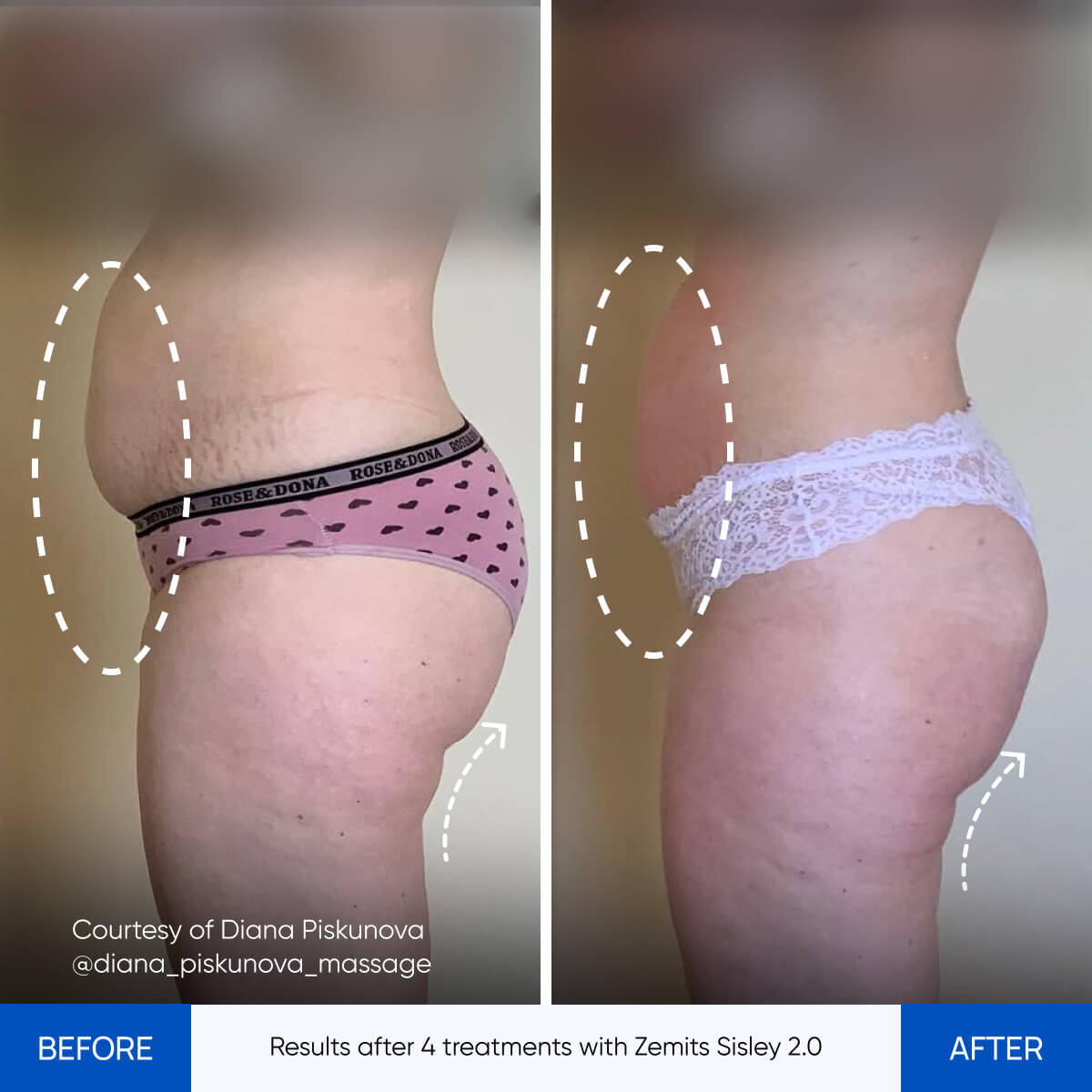 Before After Slide 3