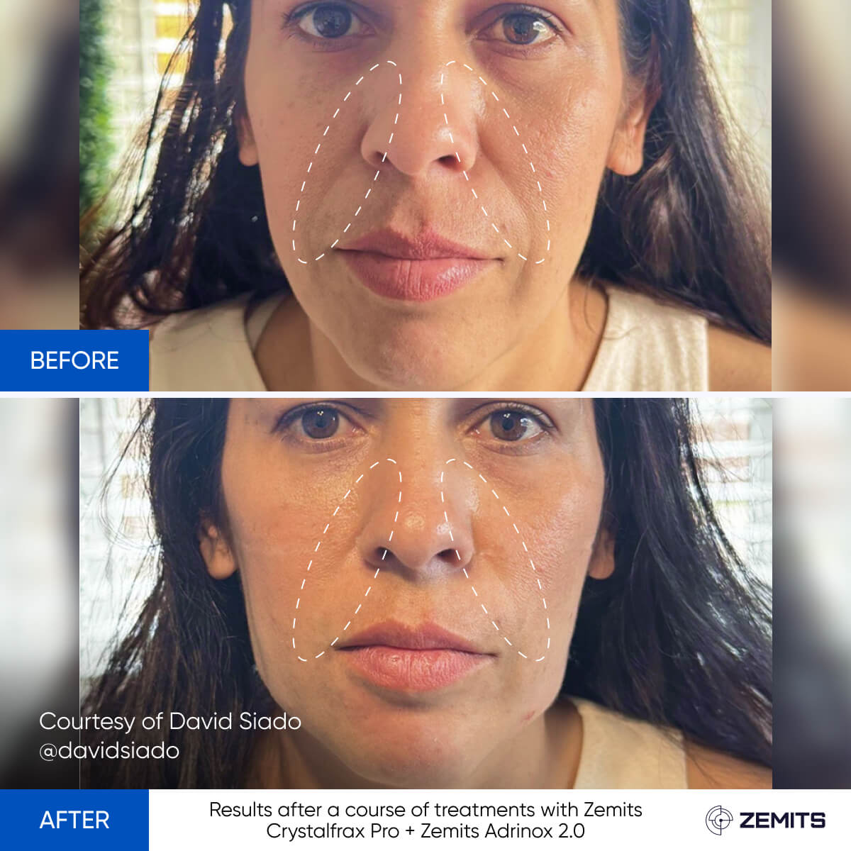 Before After Slide 3