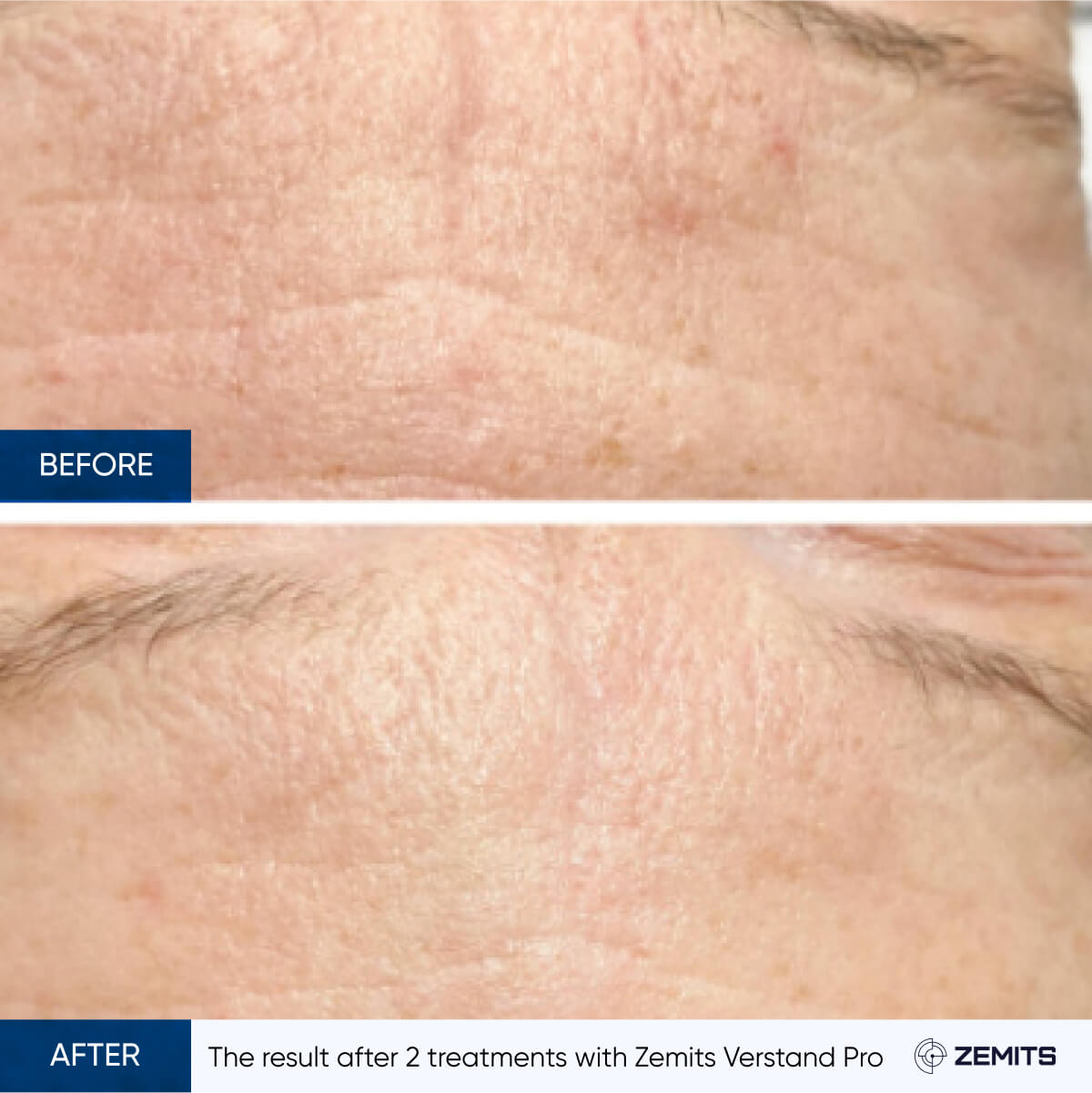 Before After Slide 11