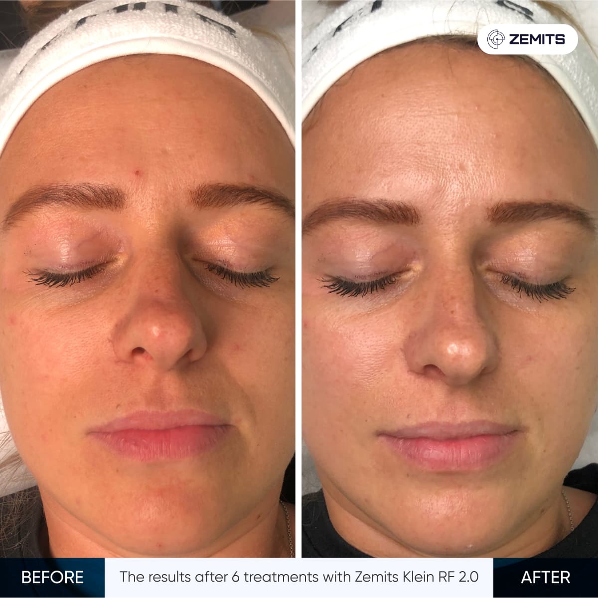 Before After Slide 4