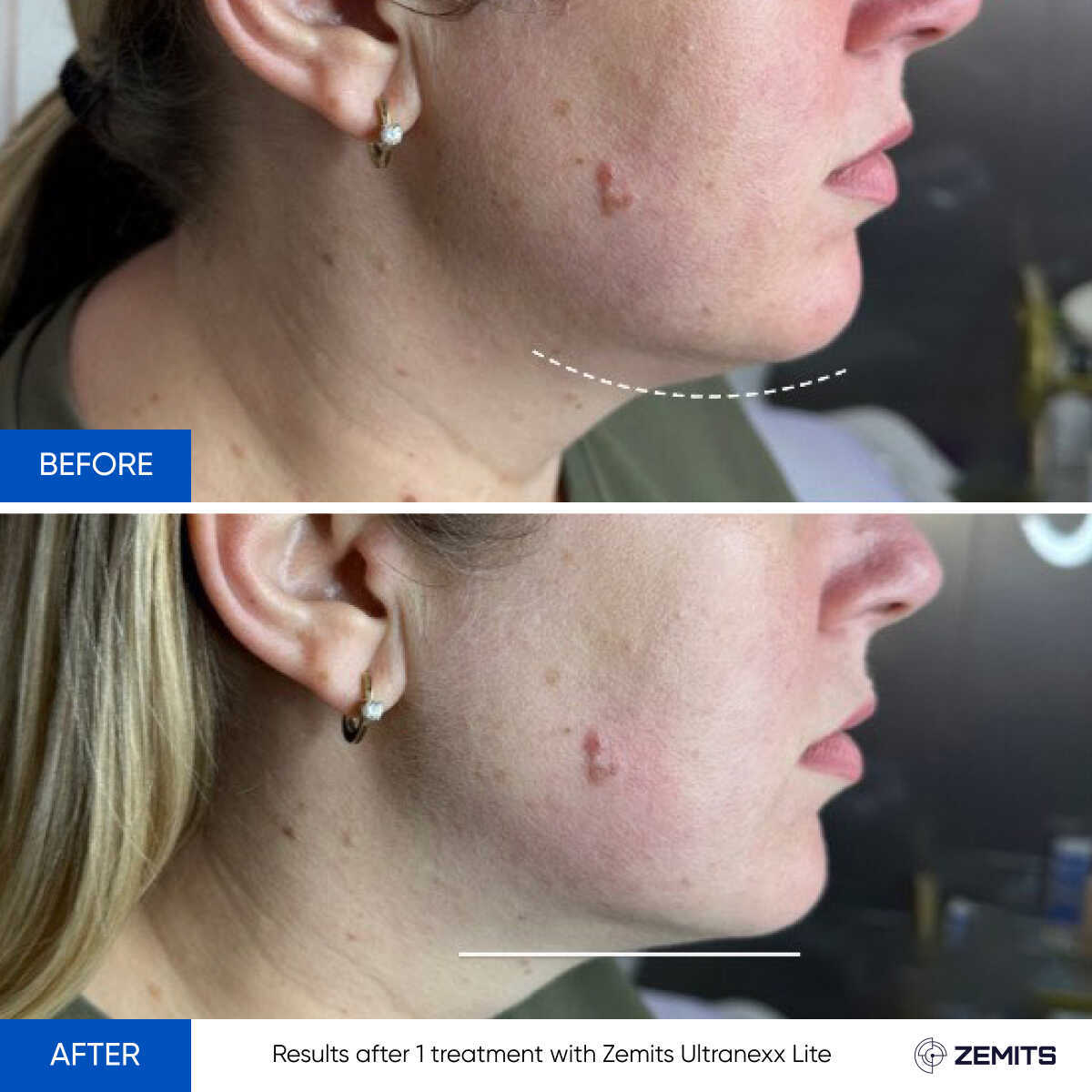 Before After Slide 4