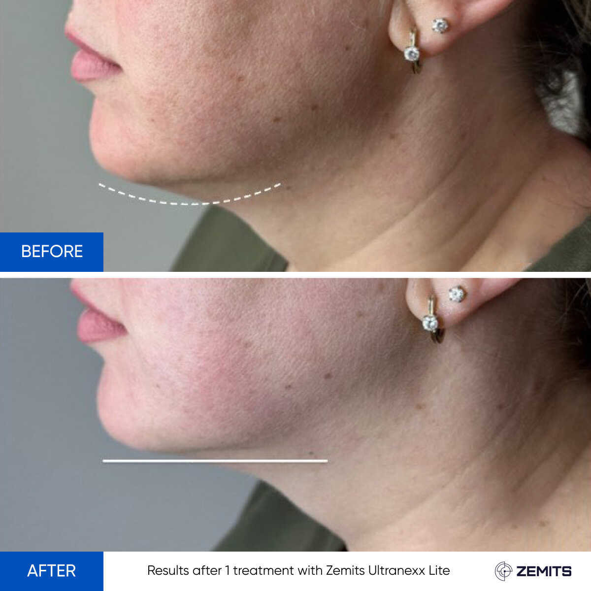 Before After Slide 5