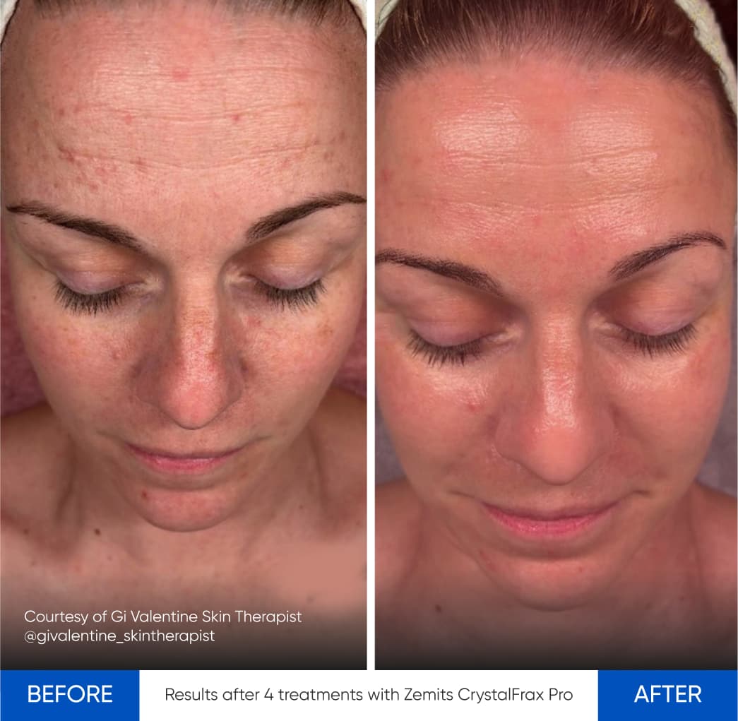 Before After Slide 1
