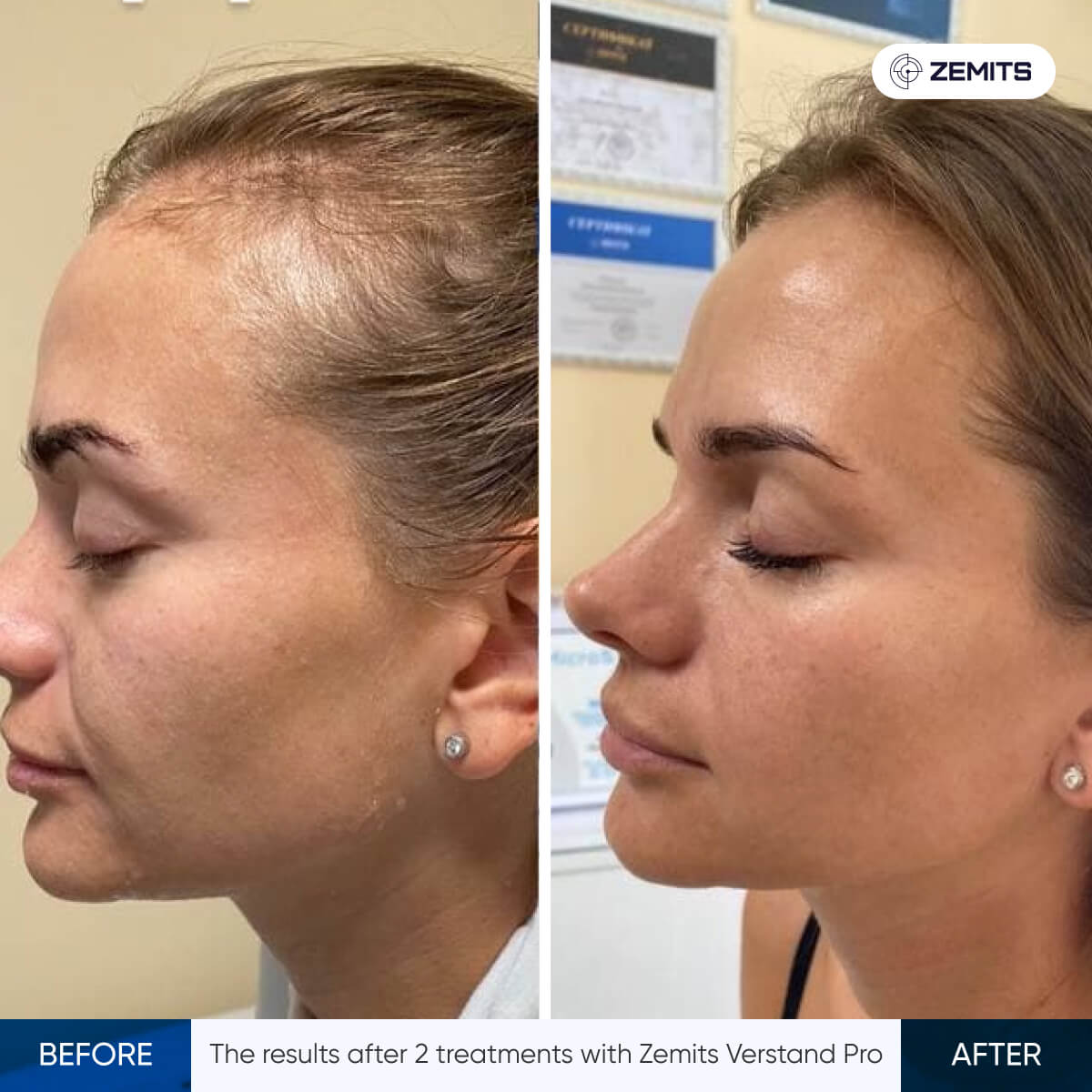 Before After Slide 17