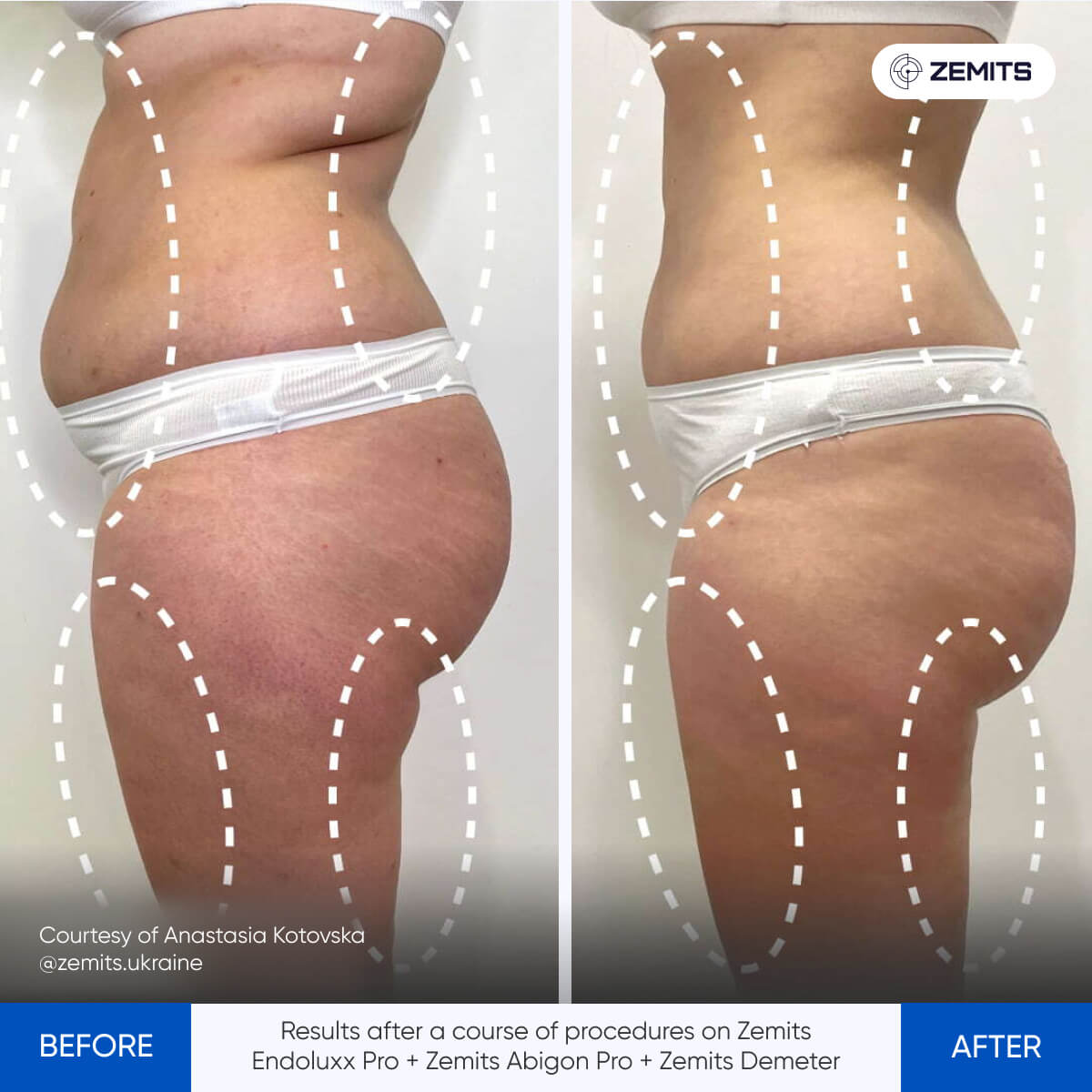 Ultrasound Cavitation - ZEMITS – Zemits EU