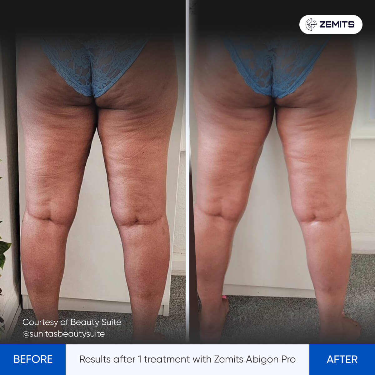Ultrasound Cavitation - ZEMITS – Zemits EU