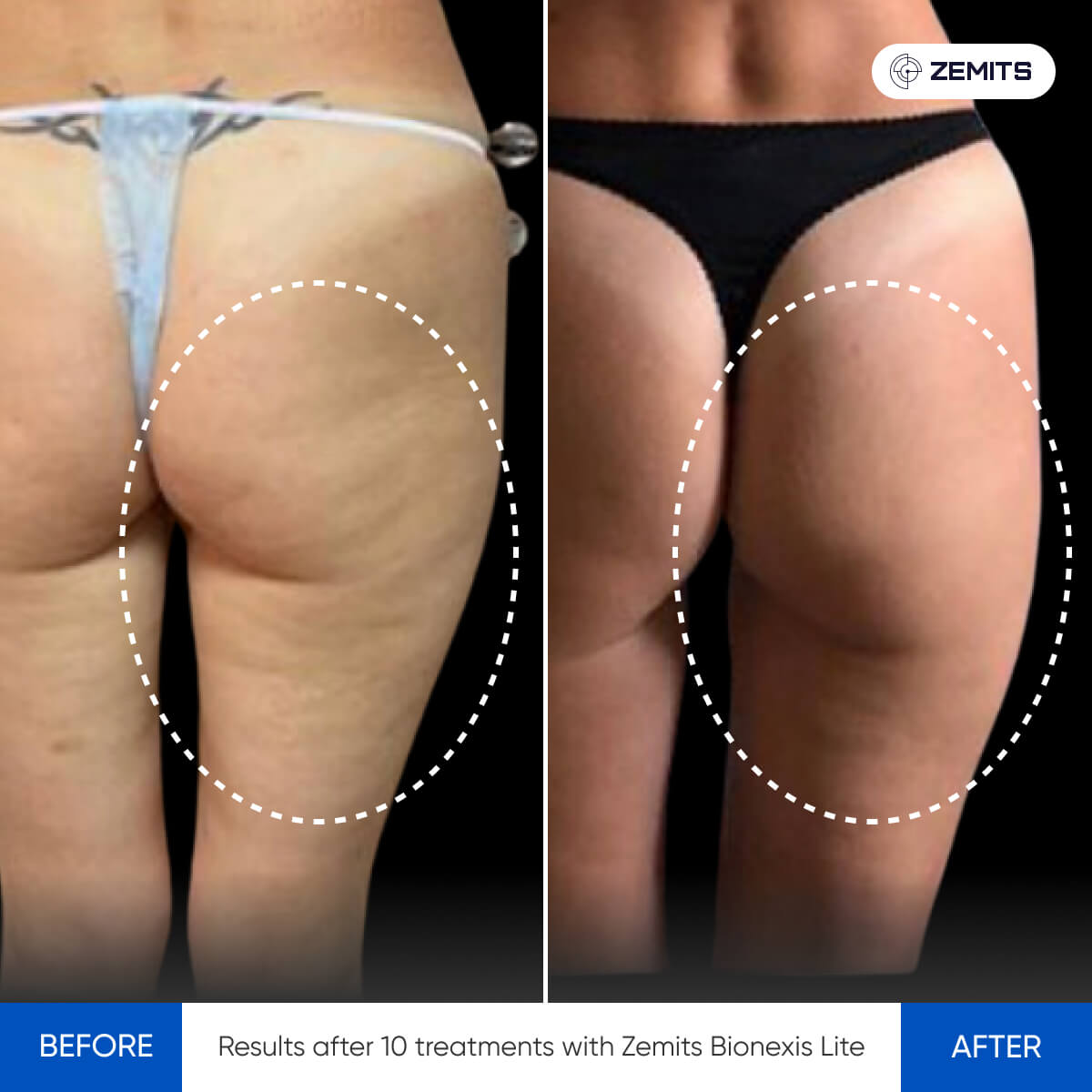 Ultrasound Cavitation - ZEMITS – Zemits EU