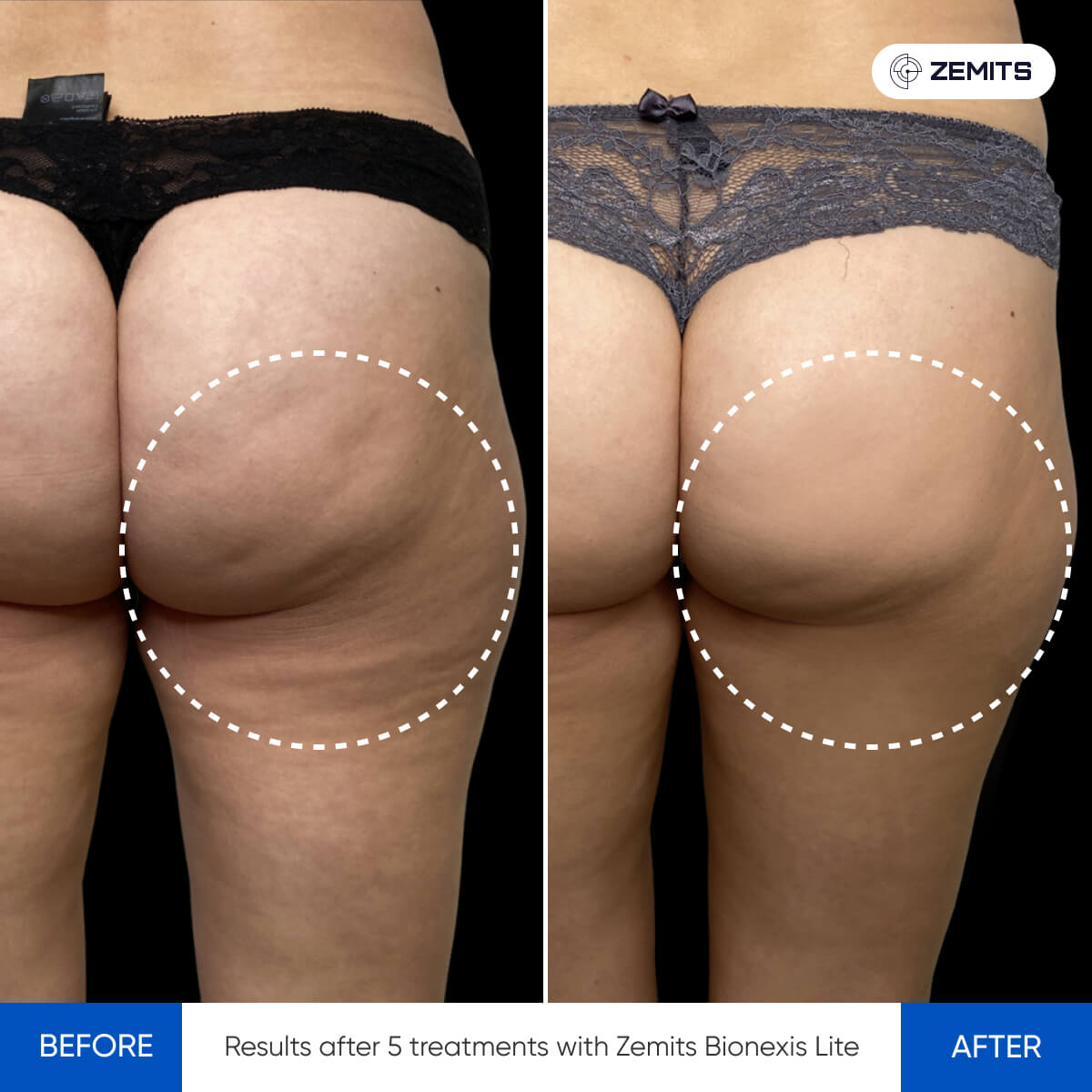 Ultrasound Cavitation - ZEMITS – Zemits EU