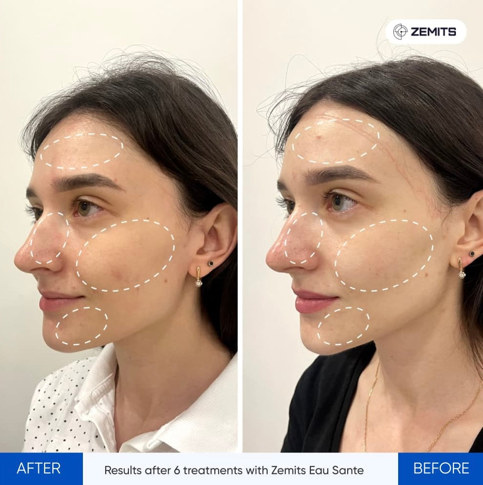 Zemits Eau Sante NG: H2O2 Hydrogen Peel Hydrodermabrasion – Zemits EU