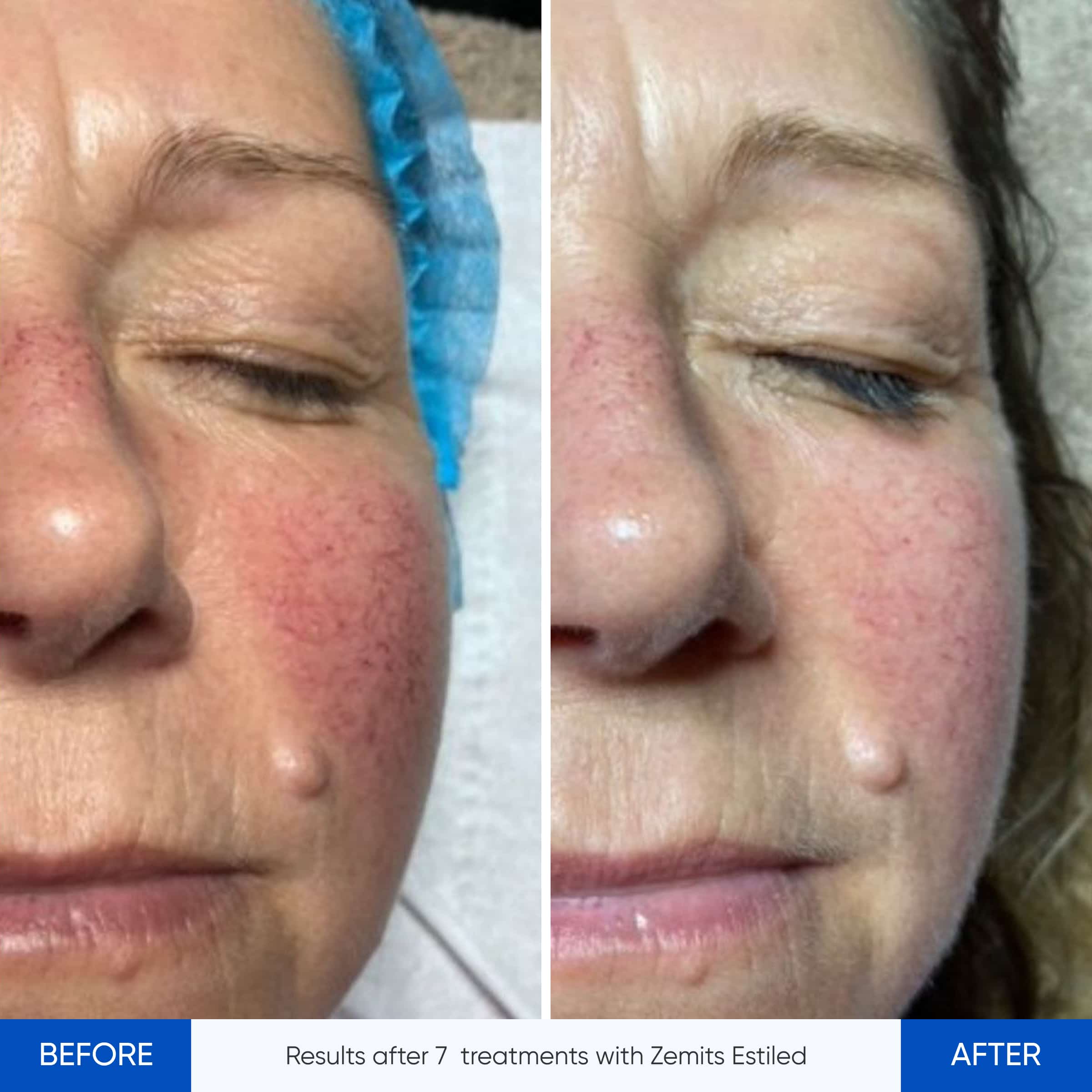 Before and after LED therapy device Zemits Estiled