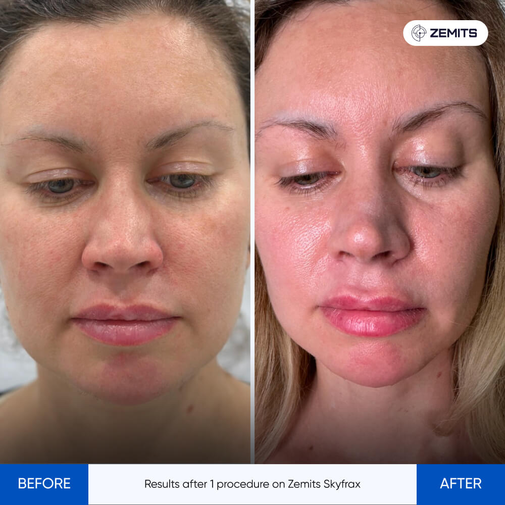 Before After Slide 1