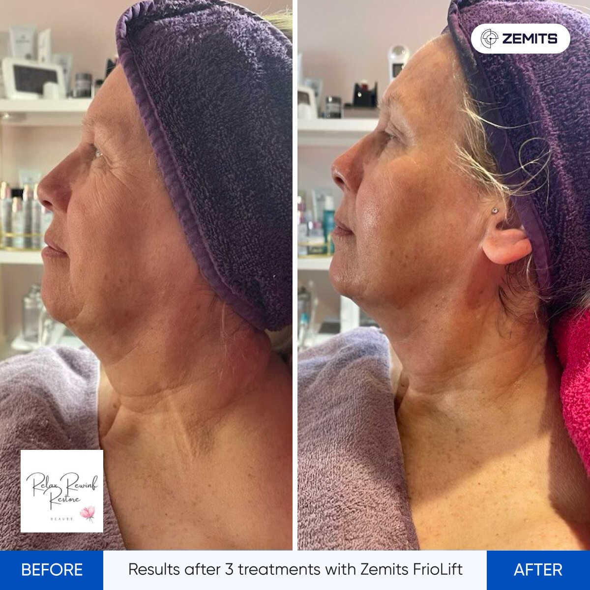 Before After Slide 2