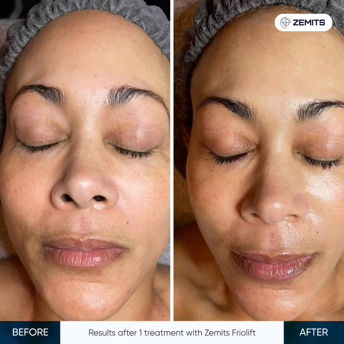 Before After Slide 3