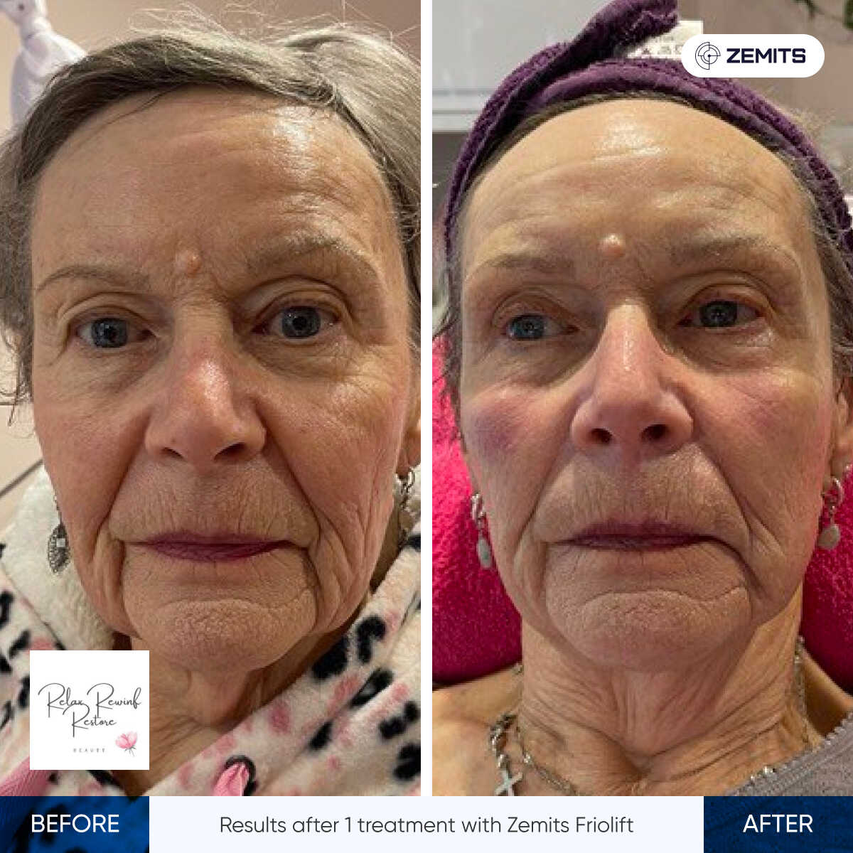 Before After Slide 4