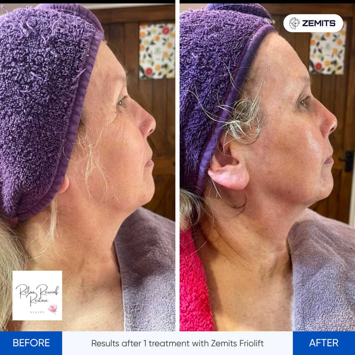 Before After Slide 5