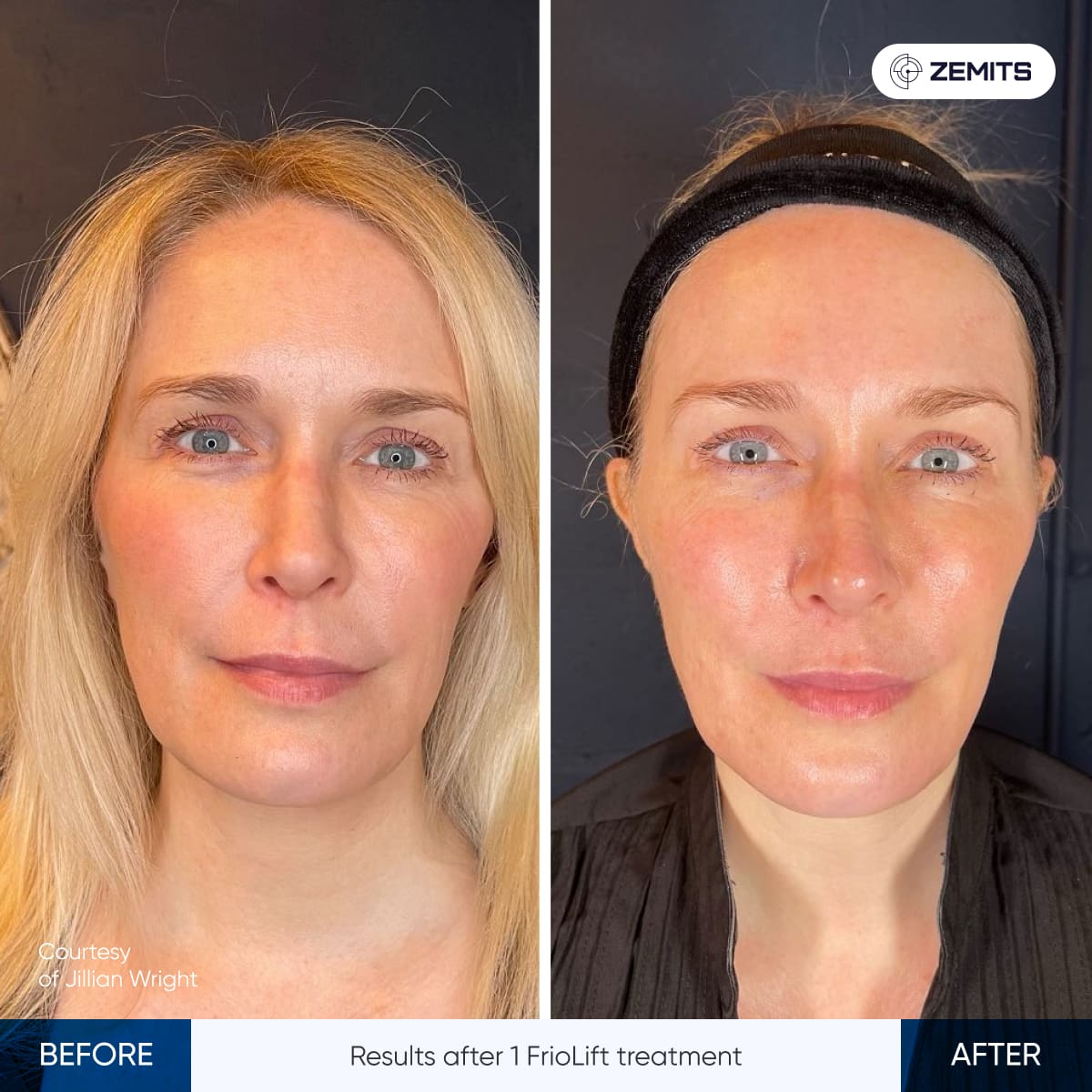 Before After Slide 7