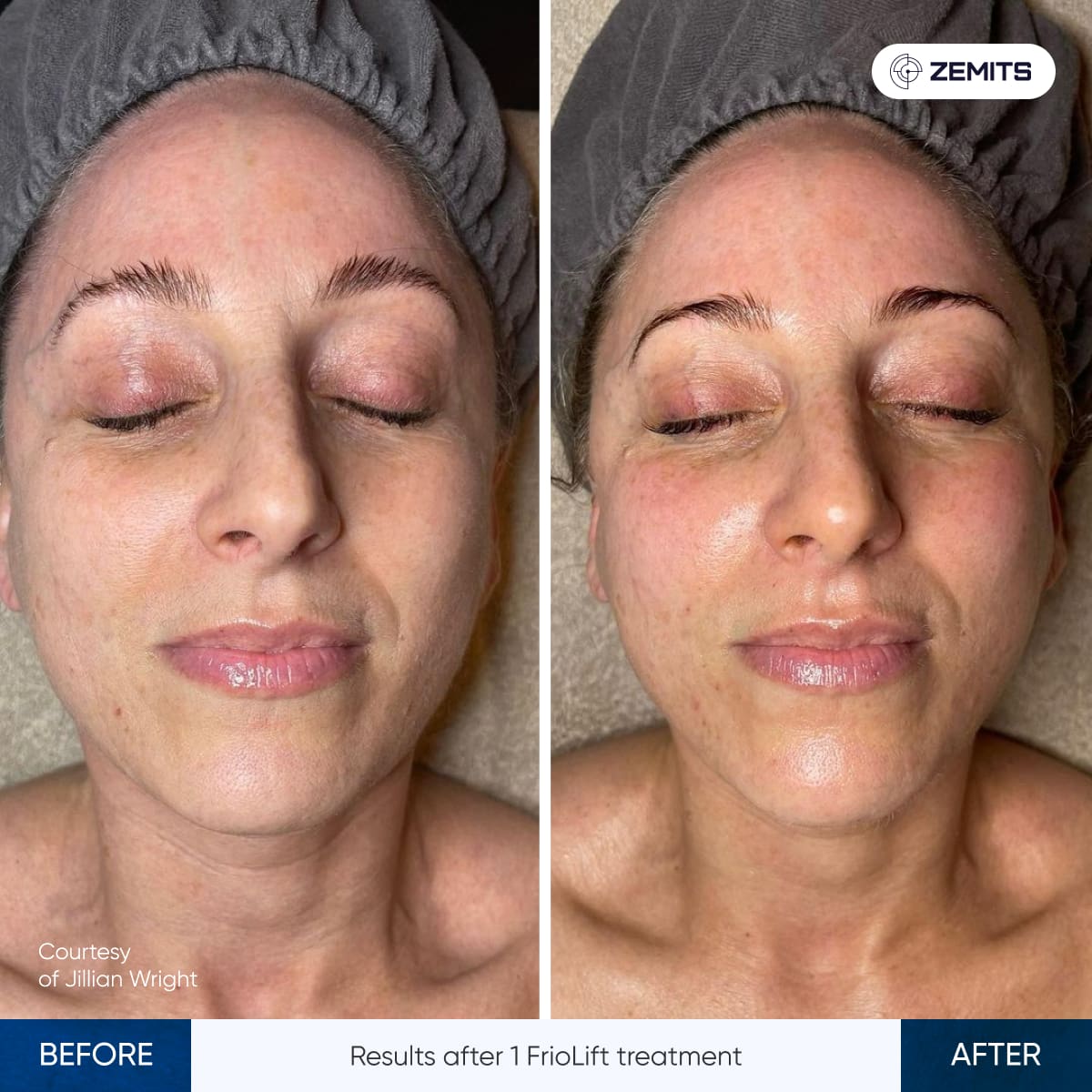 Before After Slide 8