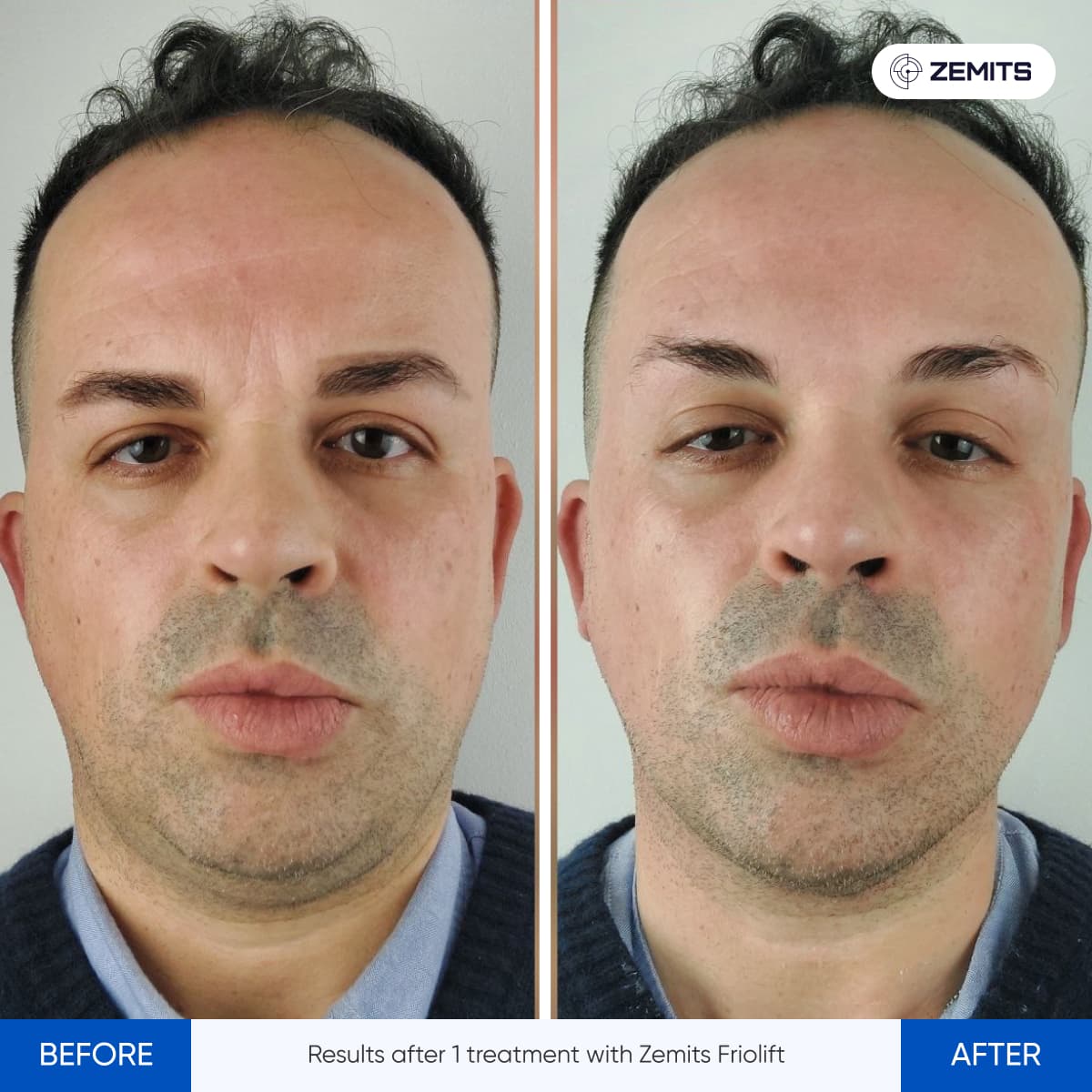 Before After Slide 9