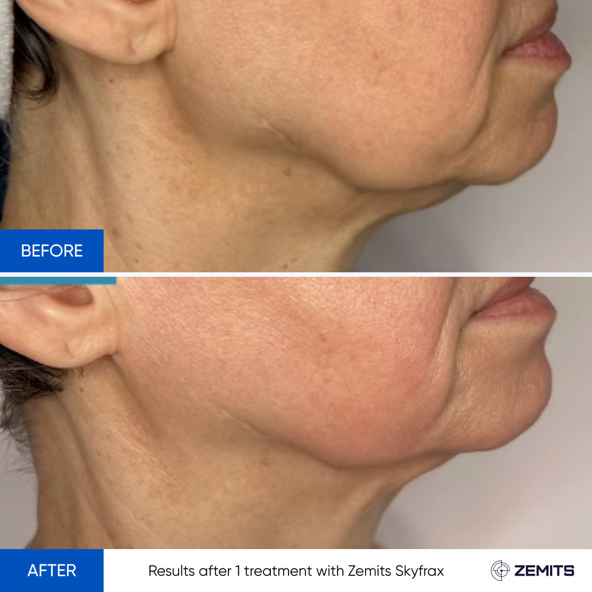 Before After Slide 1